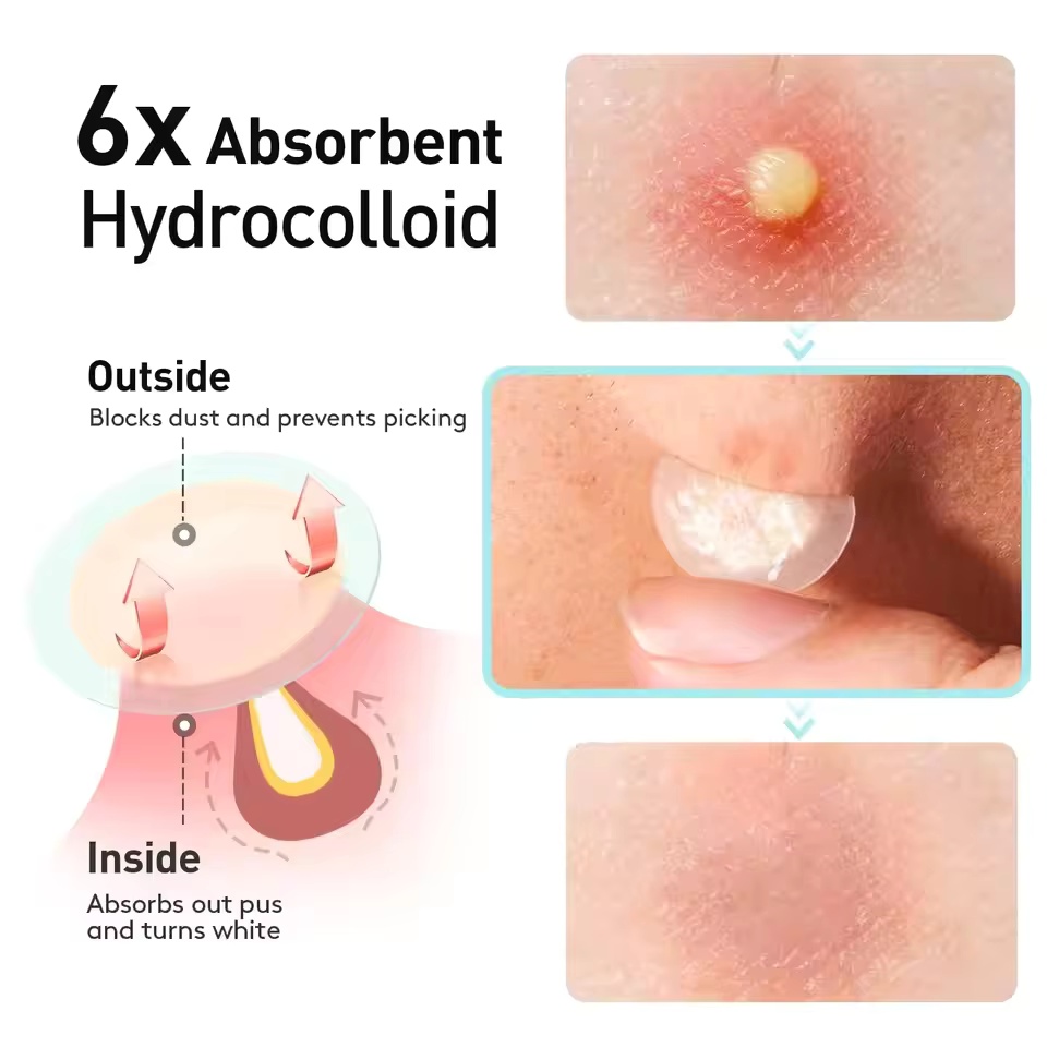 443pcs water-based gel acne pa - Skincare Basic incelemesi ve fiyatı